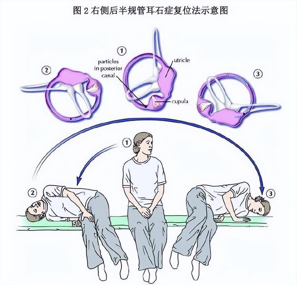 耳石復(fù)位最新技術(shù)探索，現(xiàn)代治療耳石癥的新進(jìn)展